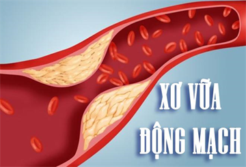 Ăn gì để giảm nguy cơ xơ vữa động mạch? | HANOITV