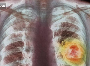 Người có 6 thói quen này có tỉ lệ mắc ung thư phổi rất cao: Hãy xem có bạn không để tránh!